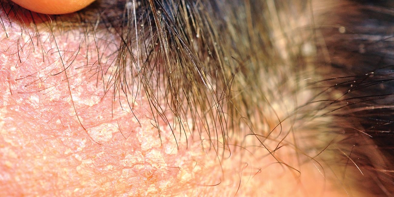Seborrheic-Dermatitis-&-Dandruff
