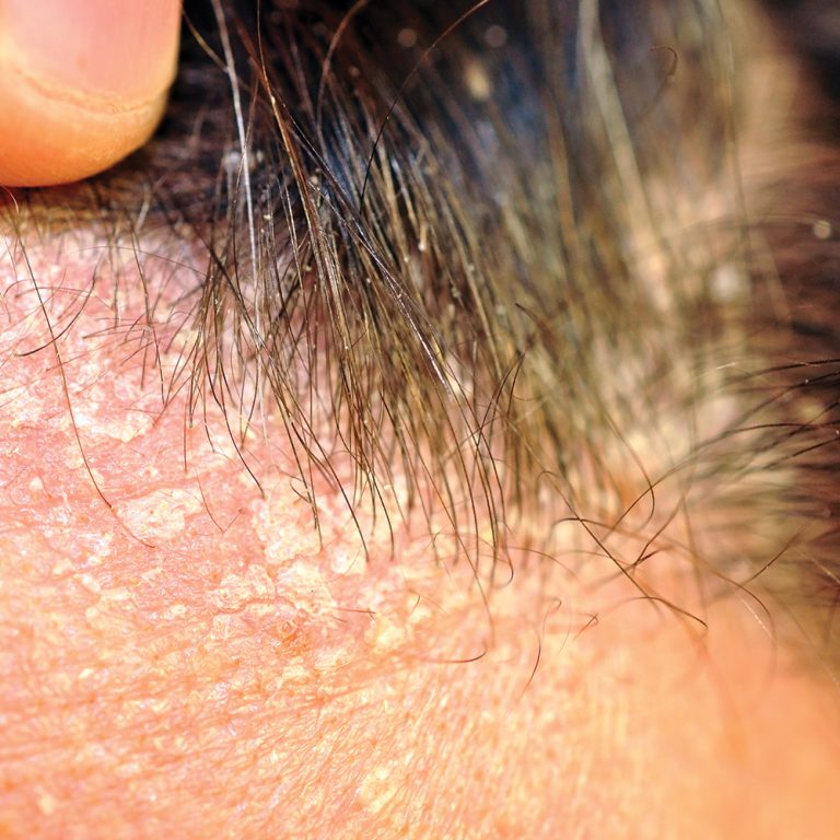 Seborrheic-Dermatitis-&-Dandruff