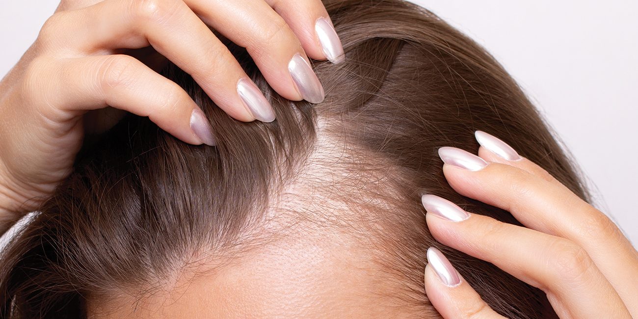 Women’s-Hair-Thinning-and-Hair-Loss-Issues