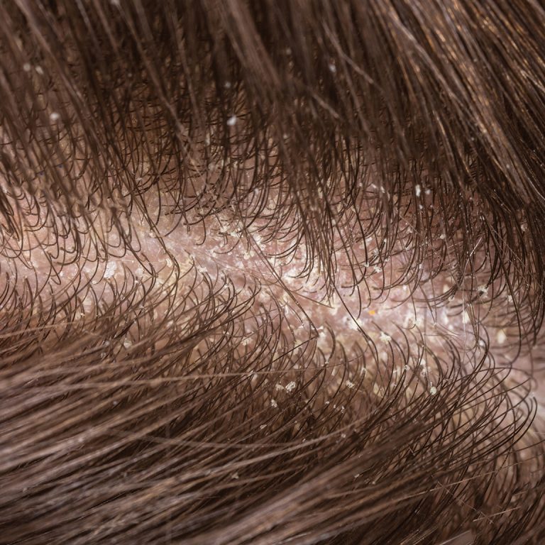 How-to-help-a-dry-scalp