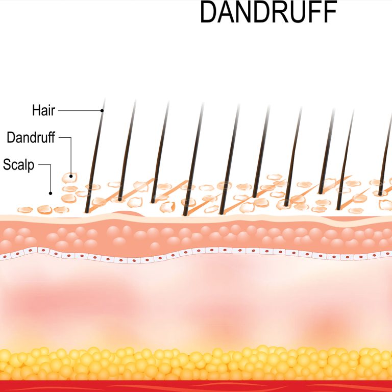 What-can-cause-dandruff